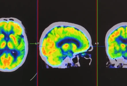 Positron emission tomography or PET images showing many phase of brain perfusion function and activity
